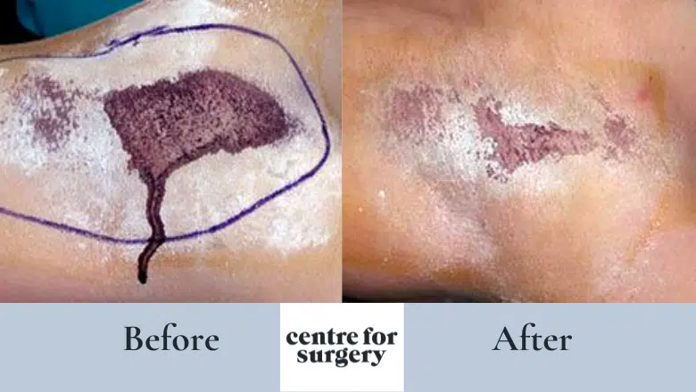 suction curettage before after