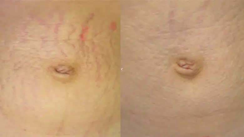 laser stretch mark removal before after