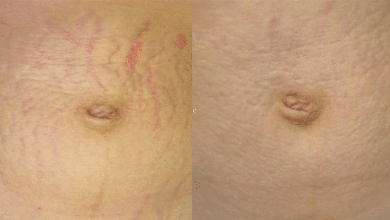laser stretch mark removal before after