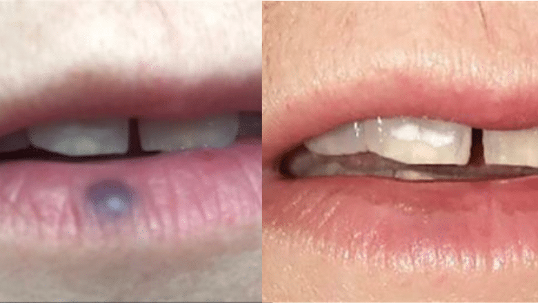 laser venous lake removal before after