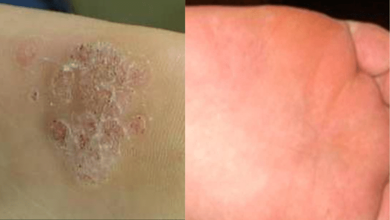 laser verruca removal before after