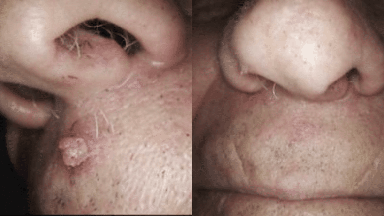 laser wart removal before after