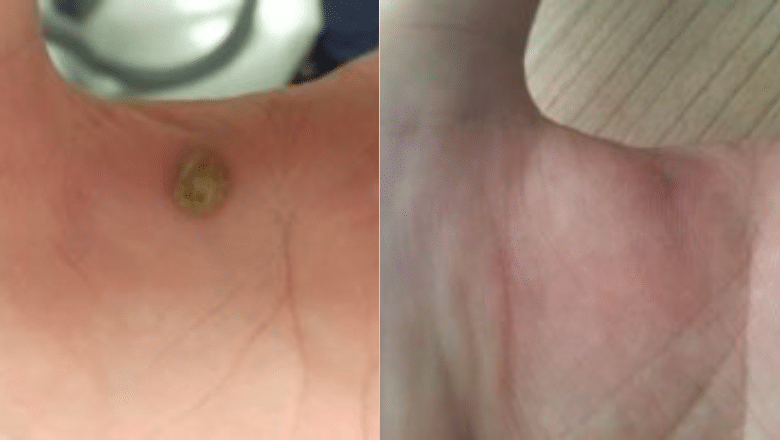 laser hand wart removal before after