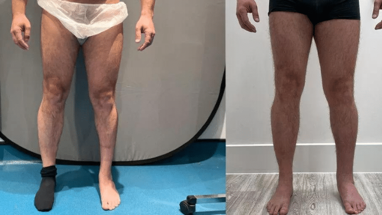 left calf augmentation before after