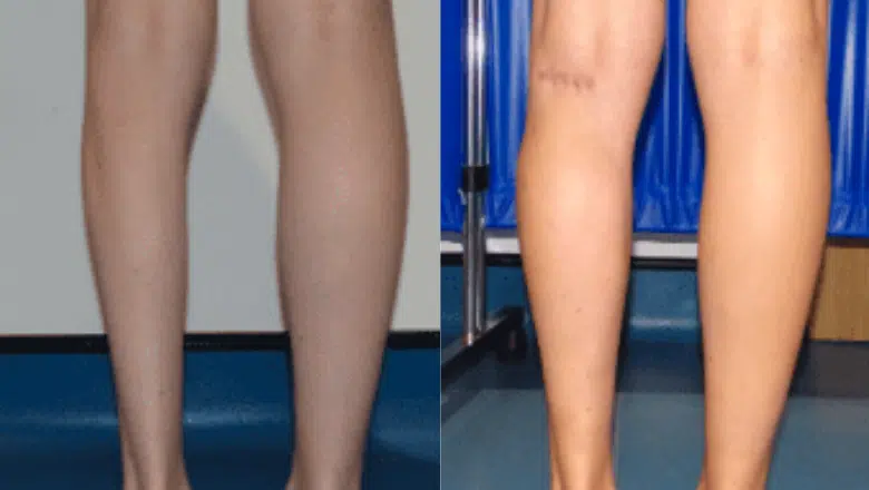 left calf augmentation implants before after 5