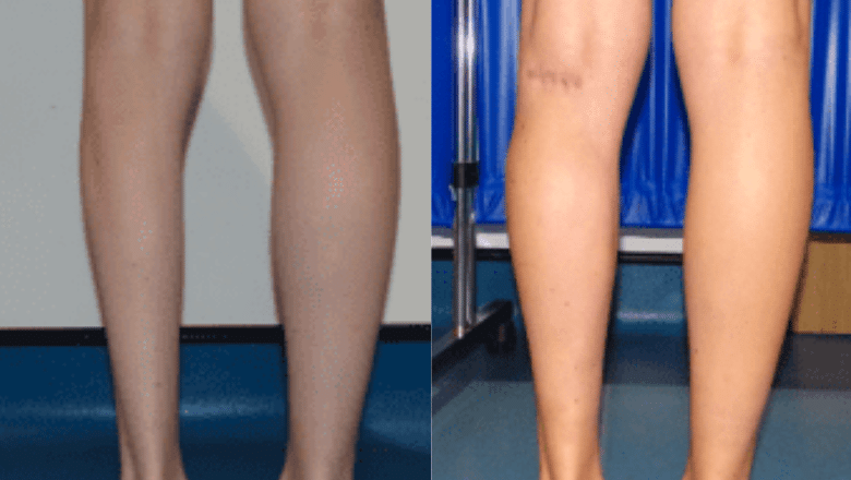 left calf augmentation implants before after 5