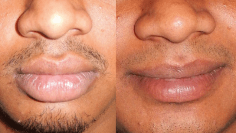 lip reduction before after