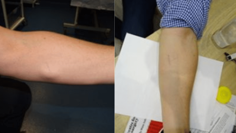 lipoma removal arm before after