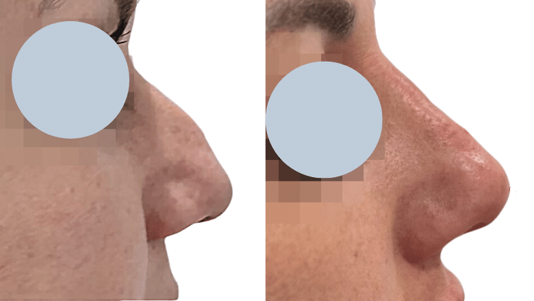 liquid rhinoplasty before after