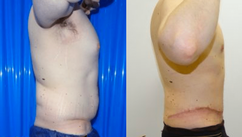 ABDOMINOPLASTY TWO MONTHS POST OP - Instant Loss - Conveniently