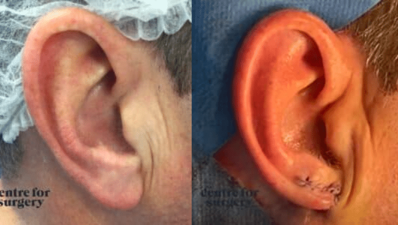 male-earlobe-reduction-before-after-2.pn