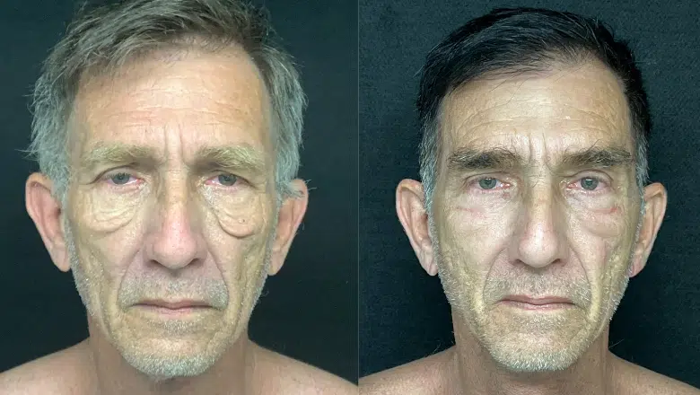 male blepharoplasty before after