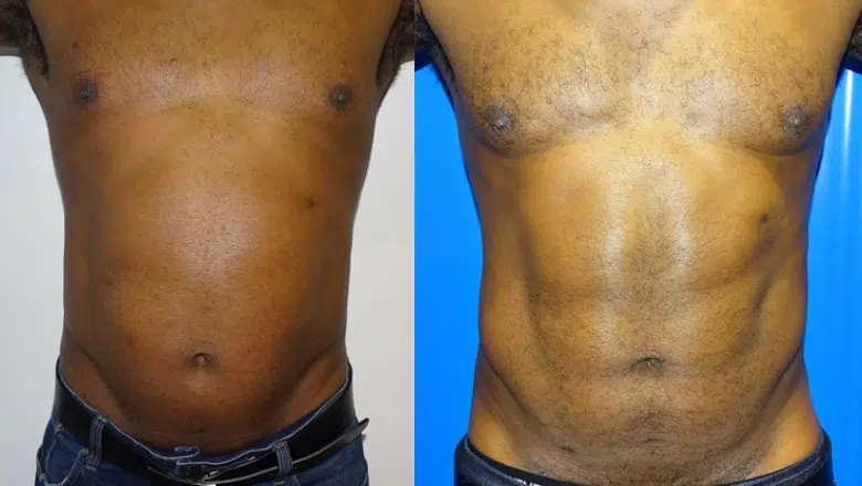 male lipo stomach before and after