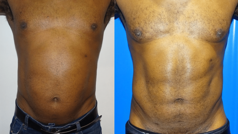 male lipo stomach before and after