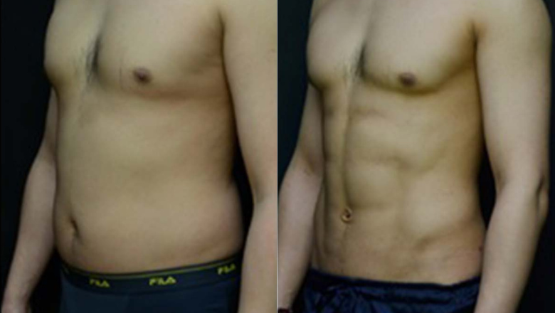 male-liposuction-abdomen-before-and-afte