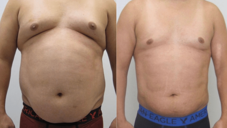 male liposuction before after 3 