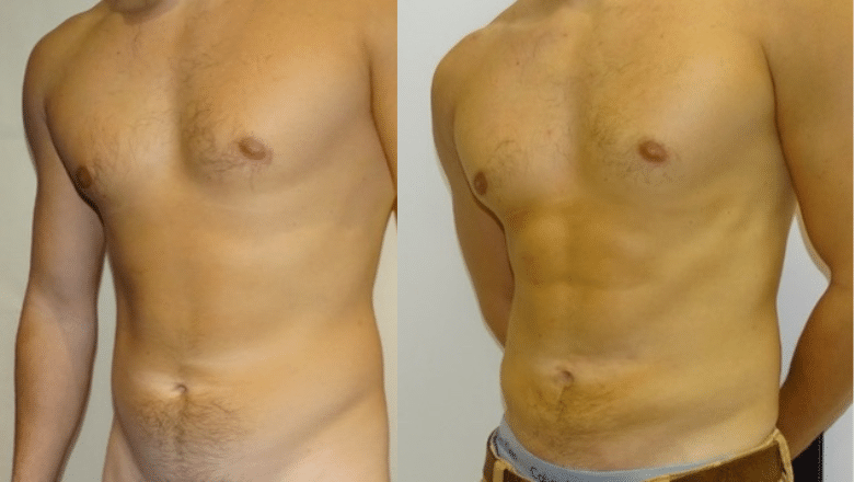 How Much Does Abdominal Etching Cost