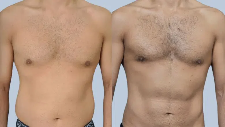 male-liposuction-before-and-after-7.png.