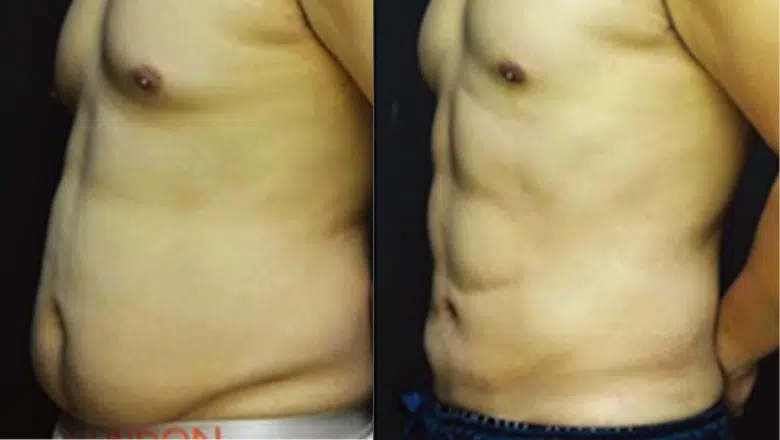 male-tummy-lipo-before-and-after.png.web