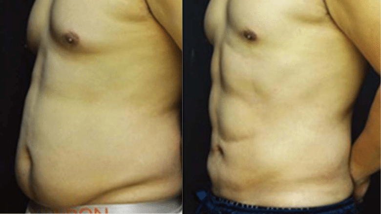 How Much Does Abdominal Etching Cost