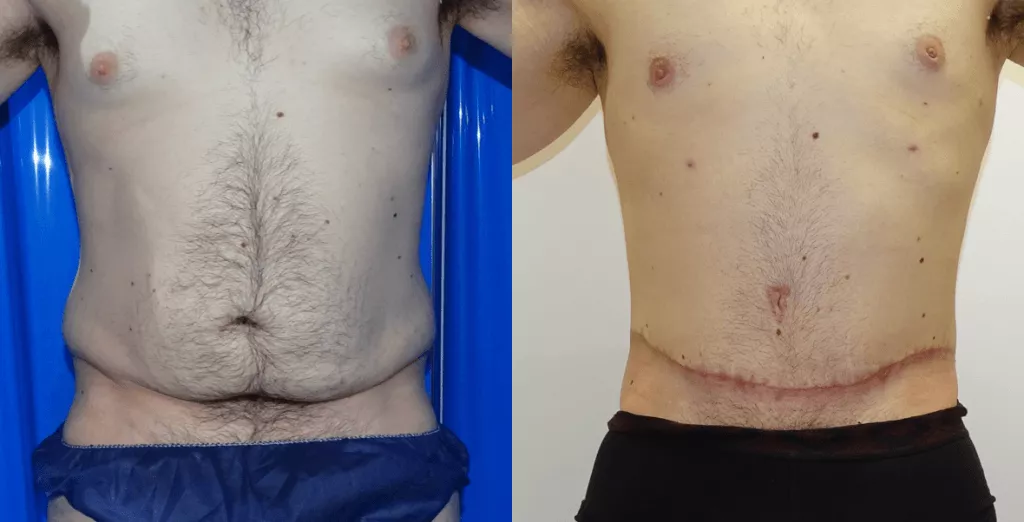 male-tummy-tuck-1.webp?format=webp&nv=ca64acd6-a6db-44c0-8ef1-3388dfd37a49