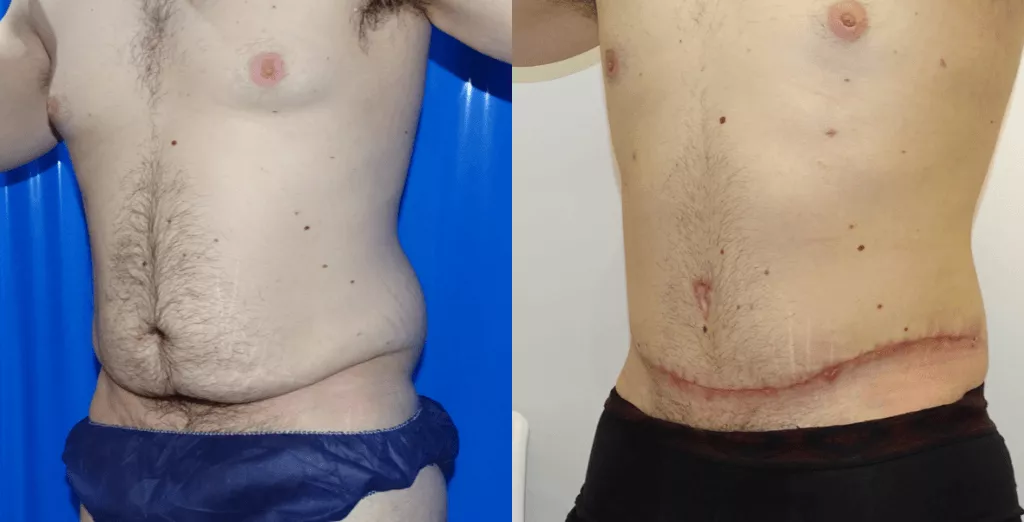male-tummy-tuck-2.webp?format=webp&nv=ca64acd6-a6db-44c0-8ef1-3388dfd37a49