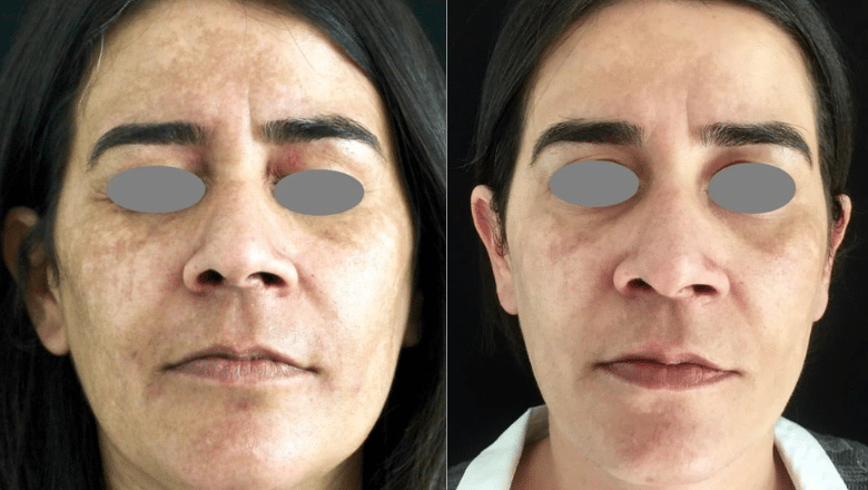 melasma laser treatment before after