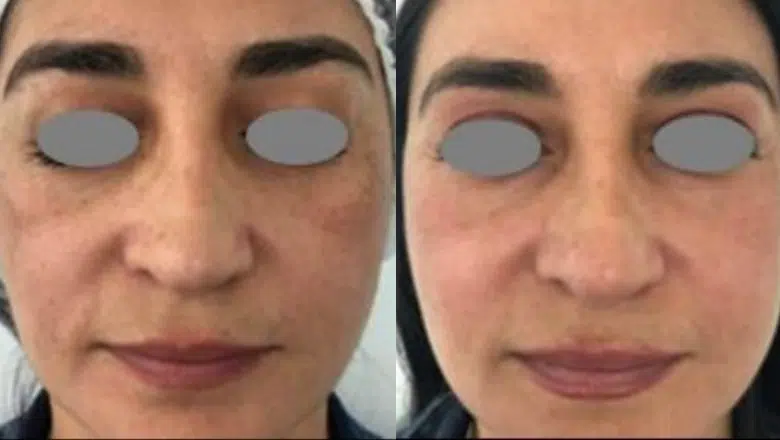 melasma laser treatment before after