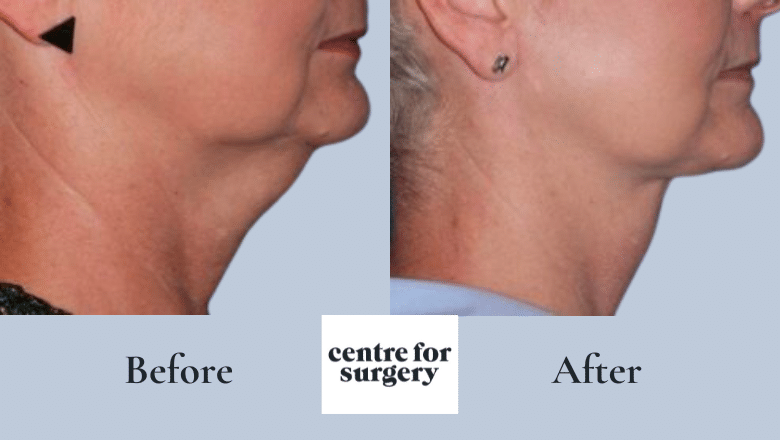 Neck Lift Options Types Of Neck Lift Surgery Centre for Surgery