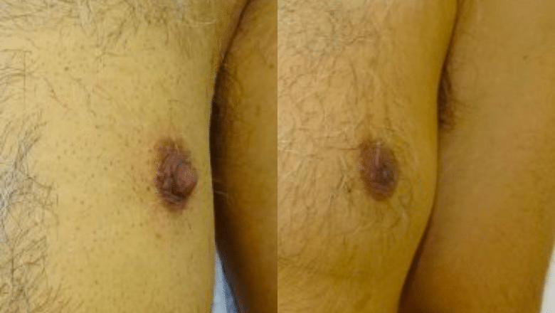 nipple reduction before after 1