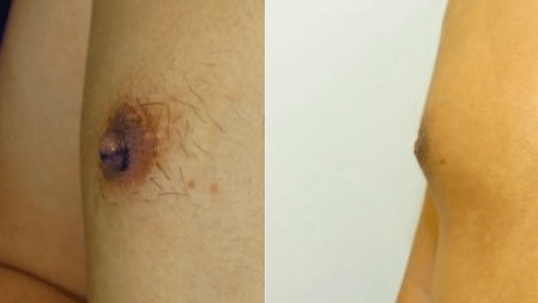 nipple reduction before after 5
