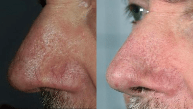 nose thread vein laser removal before after