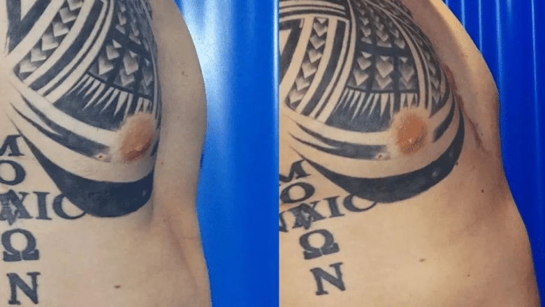 pectus implant results before after