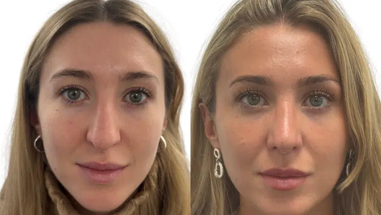 rhinoplasty before after front view hump reduction