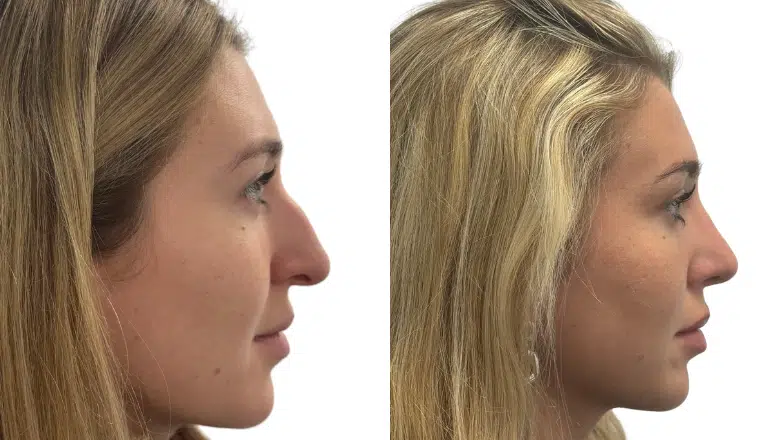 rhinoplasty before after side hump reduction