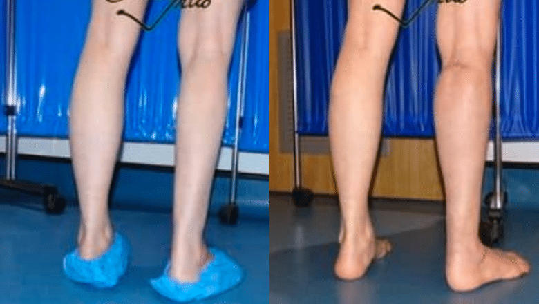 right calf augmentation implants before after 6