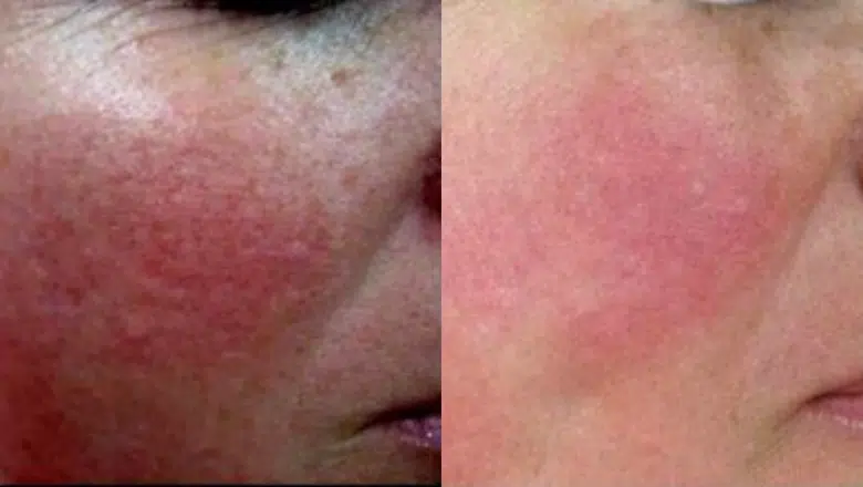 rosacea laser treatment before after