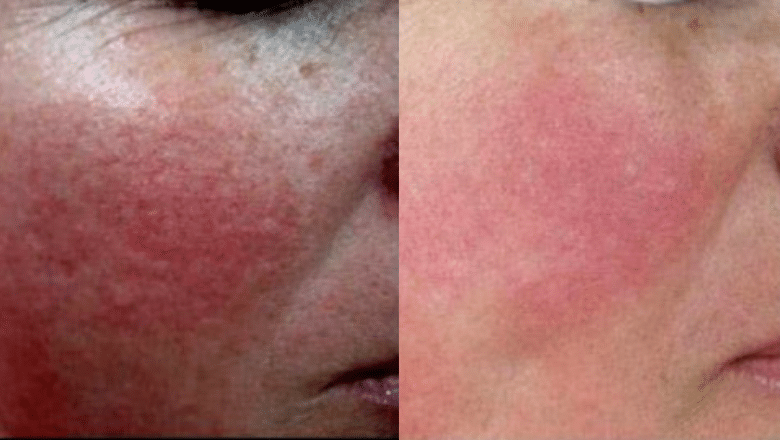 rosacea laser treatment before after