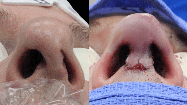 septoplasty before after 1