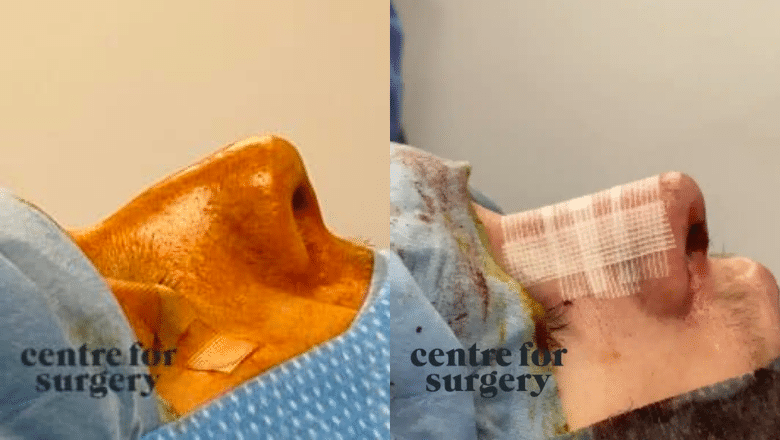 septorhinoplasty before after 1 on table