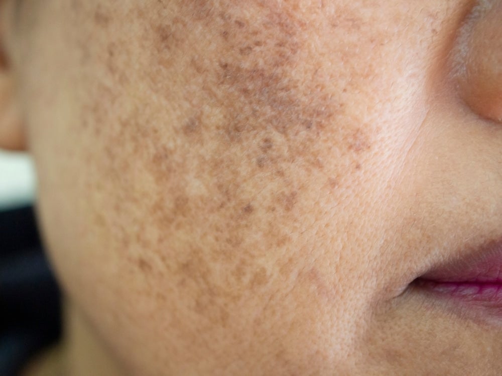 Melasma Treatment London Melasma Laser Clinic Centre for Surgery