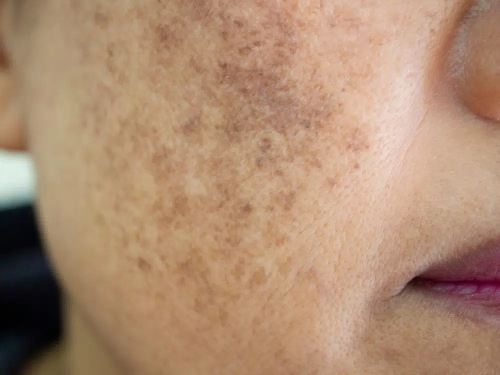 melasma treatment london