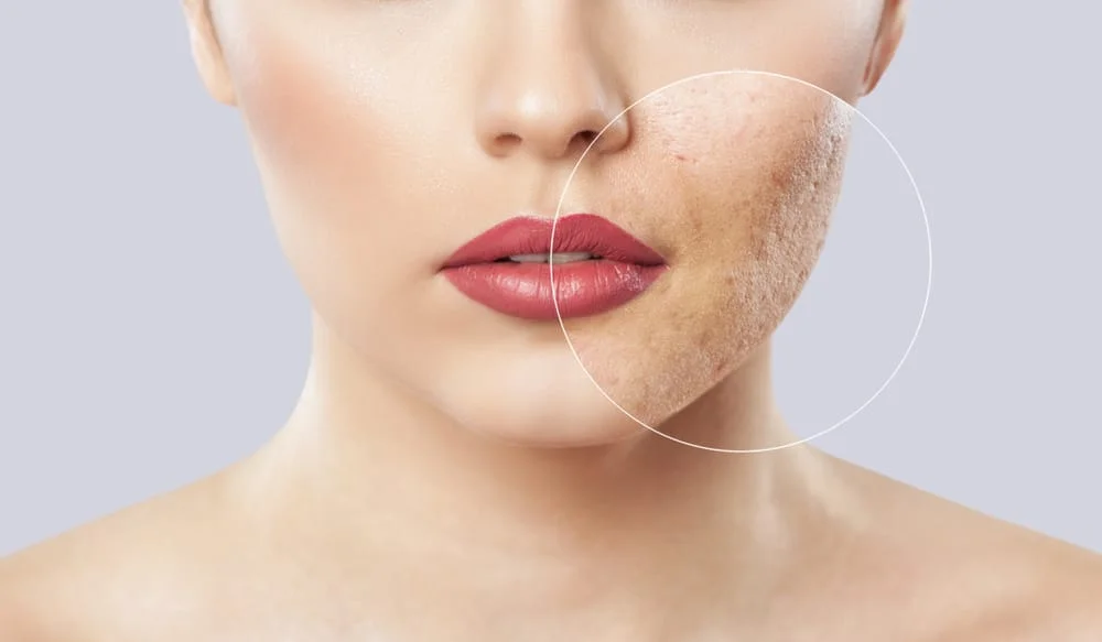 acne scar removal london