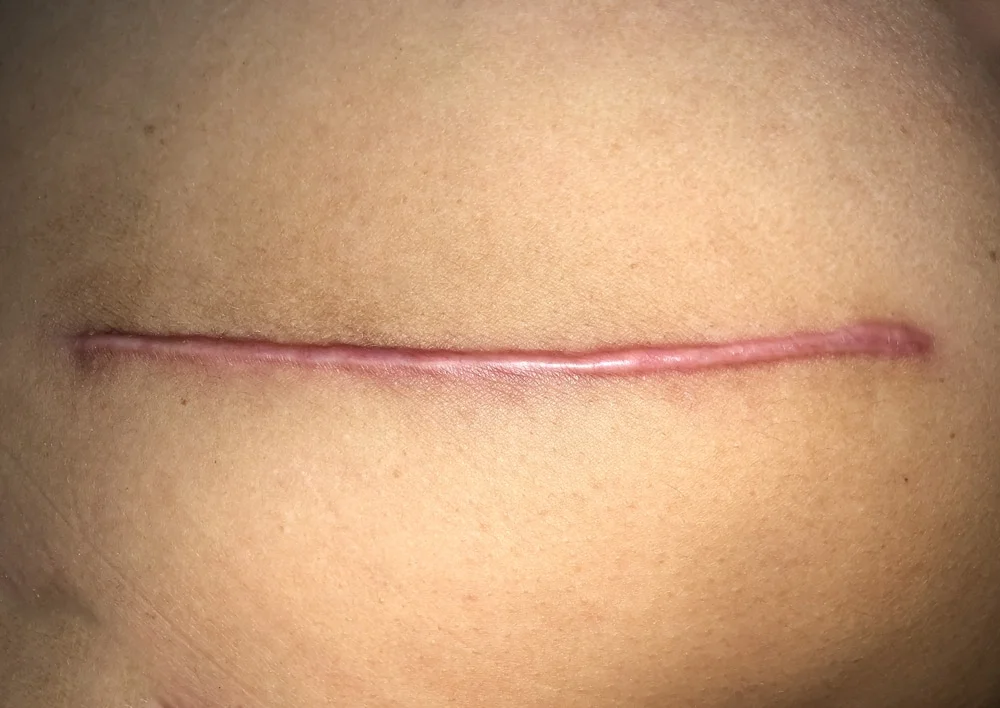 hypertrophic scar treatment