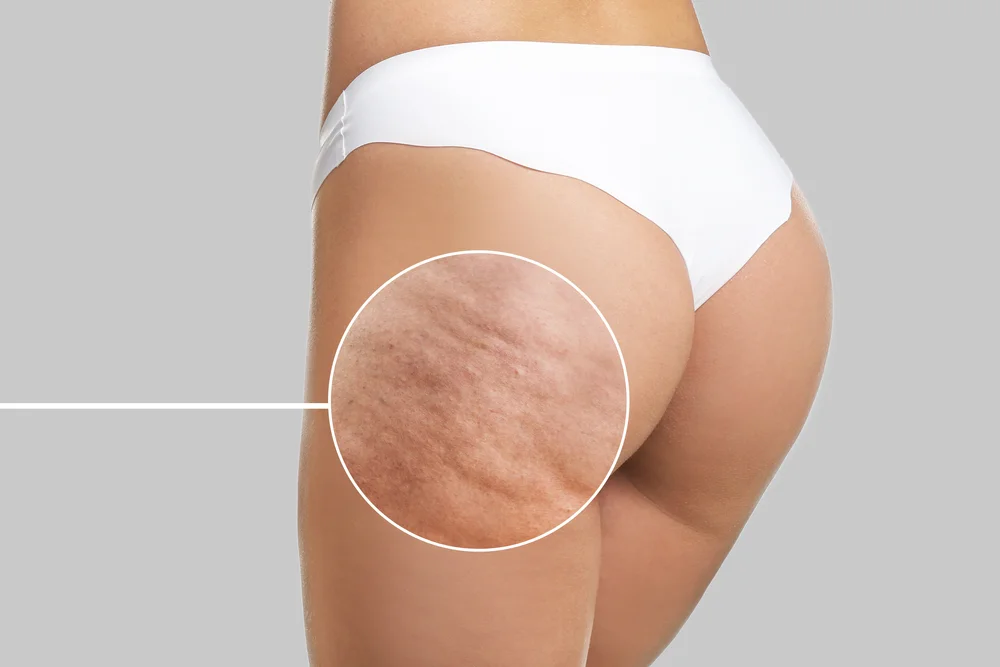Finally! A Way To Treat Cellulite That Is Non-Invasive And Effective!