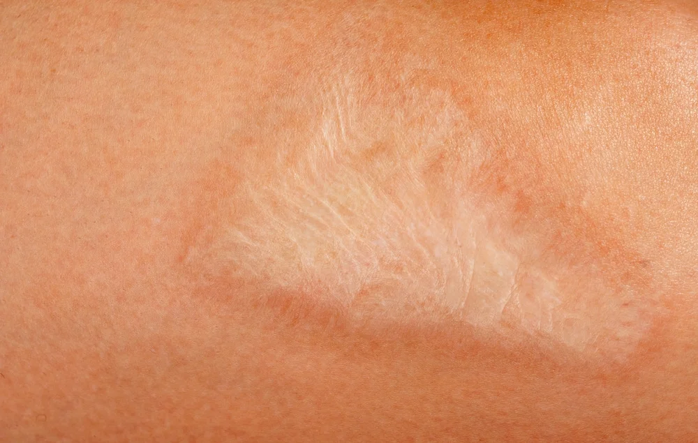 burn scars treatment