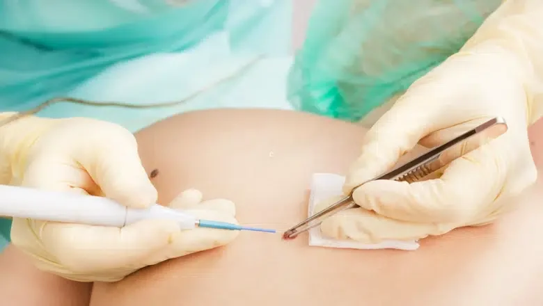 skin cancer surgery london uk