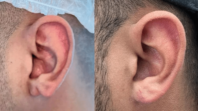 split earlobe repair before after 6