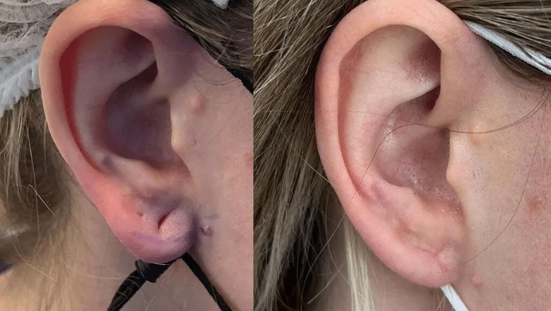 split earlobe repair before after 6