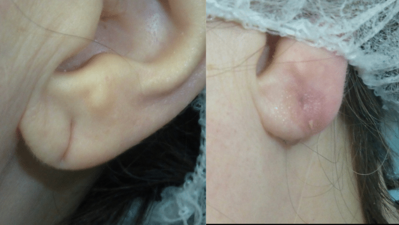 split earlobe repair before and after 4